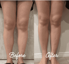 流行のミニスカ、自信をもって穿きたい40代3人が「美容医療」で脚痩せに挑戦！ 