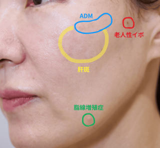 夏終わりにできたそれ、本当にシミ？ 自己判断よりもまずやるべきこととは？