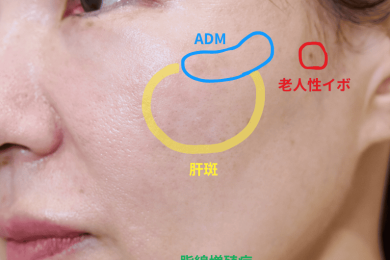 夏終わりにできたそれ、本当にシミ？ 自己判断よりもまずやるべきこととは？