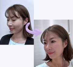 【40代・バレにくい美容医療】今、大注目！頬コケしないリフトアップ施術をSTORYライターが体験！