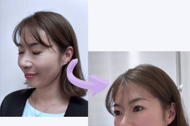 【40代・バレにくい美容医療】今、大注目！頬コケしないリフトアップ施術をSTORYライターが体験！